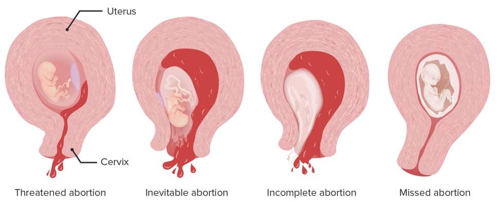 different types of abortions